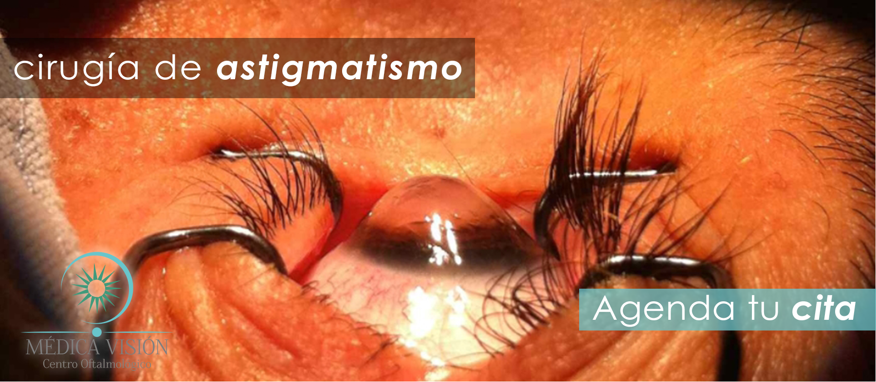  Segmentos Intraestromales 