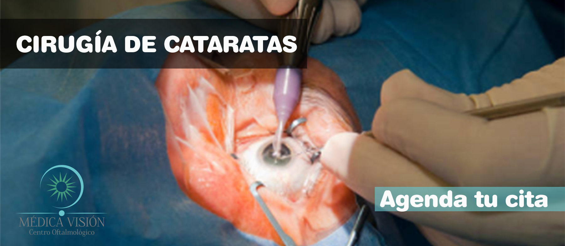  cirugia de cataratas 